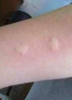 被蚊子叮了很痒很难受，不用买药擦，教你一招，10秒立马止痒(2)